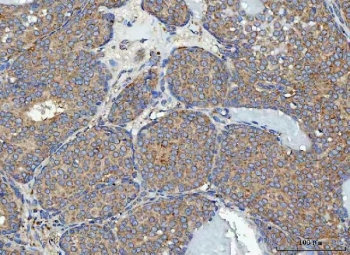 IHC staining of FFPE human breast cancer tissue with RPL32 antibody. HIER: boil tissue sections in pH8 EDTA for 20 min and allow to cool before testing.