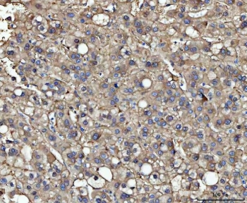 IHC staining of FFPE human liver cancer tissue with Malic enzyme 1 antibody. HIER: boil tissue sections in pH8 EDTA for 20 min and allow to cool before testing.