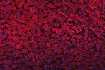 Immunofluorescent staining of FFPE human liver cancer tissue with Delta-5 desaturase antibody (red) and DAPI nuclear stain (blue). HIER: steam section in pH8 EDTA buffer for 20 min.