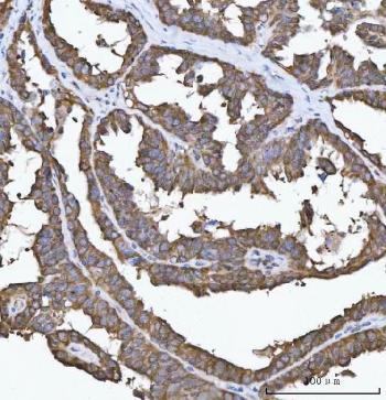 IHC staining of FFPE human ovarian cancer tissue with Delta-5 desaturase antibody. HIER: boil tissue sections in pH8 EDTA for 20 min and allow to cool before testing.