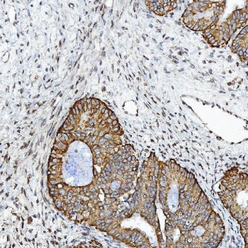IHC staining of FFPE human endometrial cancer tissue with CXCR7 antibody. HIER: boil tissue sections in pH8 EDTA for 20 min and allow to cool before testing.