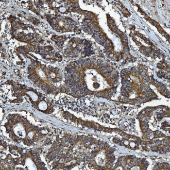IHC staining of FFPE human colon adenocarcinoma tissue with CXCR7 antibody. HIER: boil tissue sections in pH8 EDTA for 20 min and allow to cool before testing.