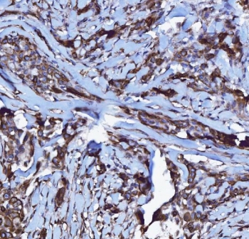 IHC staining of FFPE human breast cancer tissue with CXCR7 antibody. HIER: boil tissue sections in pH8 EDTA for 20 min and allow to cool before testing.