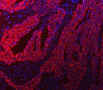 Immunofluorescent staining of FFPE human colon cancer tissue with TFG antibody (red) and DAPI nuclear stain (blue). HIER: steam section in pH8 EDTA buffer for 20 min.