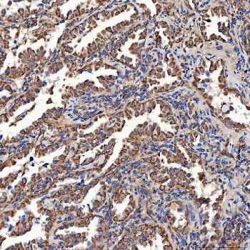 IHC staining of FFPE human lung cancer tissue with SCO1 antibody. HIER: boil tissue sections in pH8 EDTA for 20 min and allow to cool before testing.