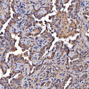 IHC staining of FFPE human lung cancer tissue with SR-BII antibody. HIER: boil tissue sections in pH8 EDTA for 20 min and allow to cool before testing.