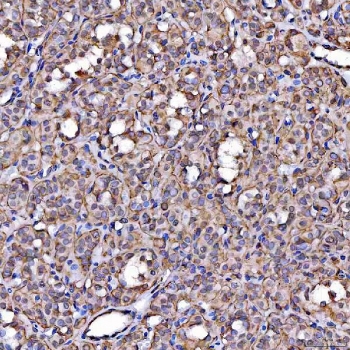 IHC staining of FFPE human thyroid cancer tissue with SR-BII antibody. HIER: boil tissue sections in pH8 EDTA for 20 min and allow to cool before testing.