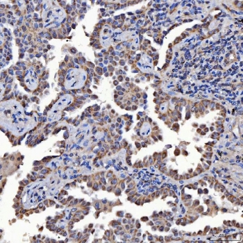 IHC staining of FFPE human lung cancer tissue with SerRS antibody. HIER: boil tissue sections in pH8 EDTA for 20 min and allow to cool before testing.