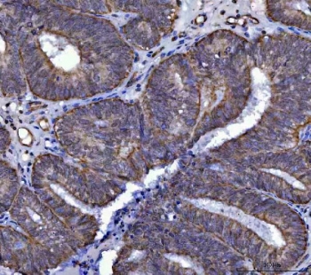 IHC staining of FFPE human endometrial cancer tissue with SerRS antibody. HIER: boil tissue sections in pH8 EDTA for 20 min and allow to cool before testing.
