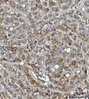 IHC staining of FFPE human liver cancer tissue with Thrombospondin-3 antibody. HIER: boil tissue sections in pH8 EDTA for 20 min and allow to cool before testing.