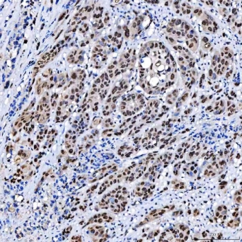 IHC staining of FFPE human prostate cancer tissue with SCML1 antibody. HIER: boil tissue sections in pH8 EDTA for 20 min and allow to cool before testing.