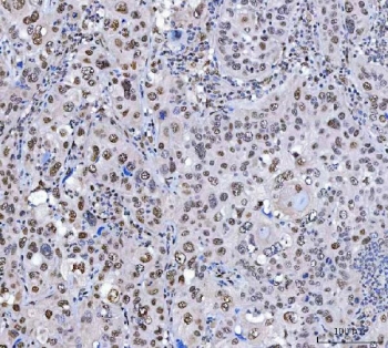 IHC staining of FFPE human laryngeal squamous cell carcinoma tissue with SCML1 antibody. HIER: boil tissue sections in pH8 EDTA for 20 min and allow to cool before testing.