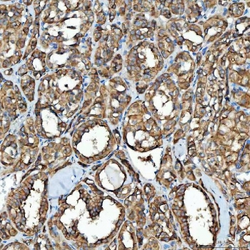 IHC staining of FFPE human thyroid cancer tissue with SDF2L1 antibody. HIER: boil tissue sections in pH8 EDTA for 20 min and allow to cool before testing.