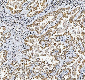 IHC staining of FFPE human lung cancer tissue with TRIR antibody. HIER: boil tissue sections in pH8 EDTA for 20 min and allow to cool before testing.