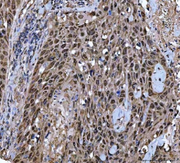 IHC staining of FFPE human penis squamous cell carcinoma tissue with TWIST1/2 antibody. HIER: boil tissue sections in pH8 EDTA for 20 min and allow to cool before testing.