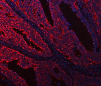 Immunofluorescent staining of FFPE human intestinal cancer tissue with DOCK1 antibody (red) and DAPI nuclear stain (blue). HIER: boil tissue sections in pH8 EDTA for 20 min and allow to cool before testing.