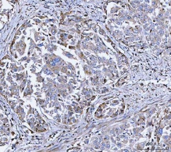 IHC staining of FFPE human lung adenocarcinoma tissue with DOCK1 antibody. HIER: boil tissue sections in pH8 EDTA for 20 min and allow to cool before testing.
