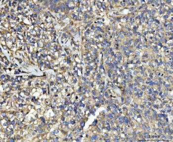 IHC staining of FFPE human breast cancer tissue with UBA5 antibody. HIER: boil tissue sections in pH8 EDTA for 20 min and allow to cool before testing.