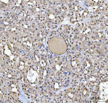 IHC staining of FFPE human thyroid cancer tissue with SAP130 antibody. HIER: boil tissue sections in pH8 EDTA for 20 min and allow to cool before testing.