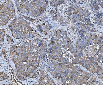 IHC staining of FFPE human liver cancer tissue with TRMT61B antibody. HIER: boil tissue sections in pH8 EDTA for 20 min and allow to cool before testing.