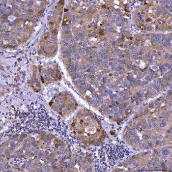 IHC staining of FFPE human liver cancer tissue with Septin 11 antibody. HIER: boil tissue sections in pH8 EDTA for 20 min and allow to cool before testing.