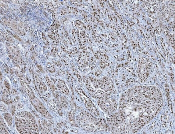 IHC staining of FFPE human breast cancer tissue with TRMT6 antibody. HIER: boil tissue sections in pH8 EDTA for 20 min and allow to cool before testing.