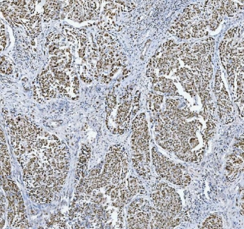 IHC staining of FFPE human cervical cancer tissue with TRMT6 antibody. HIER: boil tissue sections in pH8 EDTA for 20 min and allow to cool before testing.