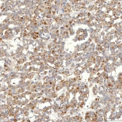 IHC staining of FFPE human thyroid papillary carcinoma tissue with SLC20A1 antibody. HIER: boil tissue sections in pH8 EDTA for 20 min and allow to cool before testing.