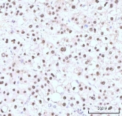 IHC staining of FFPE human liver cancer tissue with Nesprin 3 antibody. HIER: boil tissue sections in pH8 EDTA for 20 min and allow to cool before testing.