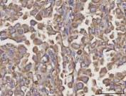 IHC staining of FFPE human lung cancer tissue with NDUFA4 antibody. HIER: boil tissue sections in pH8 EDTA for 20 min and allow to cool before testing.