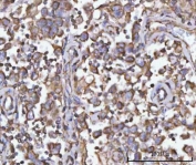 IHC staining of FFPE human testicular seminoma tissue with PFKFB1 antibody. HIER: boil tissue sections in pH8 EDTA for 20 min and allow to cool before testing.