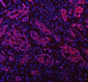 Immunofluorescent staining of FFPE human lung adenocarcinoma tissue with PAPSS2 antibody (red) and DAPI nuclear stain (blue). HIER: steam section in pH8 EDTA buffer for 20 min.