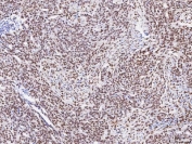 IHC staining of FFPE human ovarian serous adenocarcinoma tissue with RBFOX2 antibody. HIER: boil tissue sections in pH8 EDTA for 20 min and allow to cool before testing.