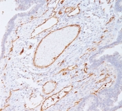 PECAM-1 antibody C31.7 immunohistochemistry colon carcinoma (clone C31.7).