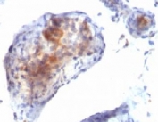 IHC testing of testicular carcinoma with FOXP3 antibody.