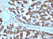 IHC: Formalin-fixed, paraffin-embedded human hepatocellular carcinoma stained with CPS1 antibody (SPM615).