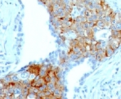 IHC: Formalin-fixed, paraffin-embedded human lung squamous cell carcinoma stained with TRIM29 antibody (clone TRIM29/1041).
