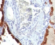 IHC: Formalin-fixed, paraffin-embedded human lung carcinoma stained with Cytokeratin 7 antibody (clone KRT7/760).