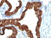 IHC: Formalin-fixed, paraffin-embedded human ovarian carcinoma stained with Keratin 7 antibody (KRT7/1198)