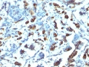 IHC: Formalin-fixed, paraffin-embedded human gastric carcinoma stained with anti-MUC3 antibody (SPM200).