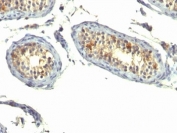 IHC: Formalin-fixed, paraffin-embedded human testicular carcinoma stained with TGF-alpha antibody (clone P/T1).