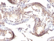 IHC testing of formalin-fixed, paraffin-embedded human testicular carcinoma stained with TGFa antibody (clone TGFA/1119).