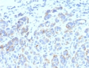 IHC: Formalin-fixed, paraffin-embedded human melanoma stained with TRP1 antibody (SPM611)