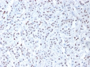 IHC testing of FFPE human mesothelioma with Wilms Tumor 1 antibody (clone 6F-H2). Required HIER: boil tissue sections in pH 9 10mM Tris with 1mM EDTA for 10-20 min followed by cooling at RT for 20 min.