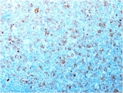 IHC testing of formalin-fixed, paraffin-embedded human tonsil with CDC2 antibody (CDK1/873). Staining of formalin-fixed tissues requires boiling tissue sections in pH 9 10mM Tris with 1mM EDTA for 10-20 min followed by cooling at RT for 20 min.