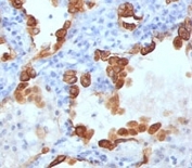 IHC: Formalin-fixed, paraffin-embedded human lung carcinoma stained with Cytokeratin 8/18 antibody (B22.1 + B23.1).