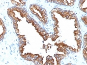 IHC analysis of FFPE human prostate carcinoma with Cytokeratin 8/18 antibody (clone KRT8.18/1346). Required HIER: boil tissue sections in pH 9 10mM Tris with 1mM EDTA for 10-20 min.