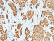 IHC testing of FFPE human melanoma with recombinant S100B antibody (clone S100B/1706R). HIER: steam sections in pH 9 10mM Tris with 1mM EDTA for 10-20 min.