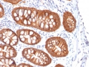 IHC testing of colon carcinoma with recombinant  Ep-CAM antibody (clone rVU-1D9). Required HIER: boil tissue sections in 10mM citrate buffer, pH 6, for 10-20 min followed by cooling at RT for 20 min.
