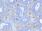 IHC testing of FFPE human cervix with HPV-16 E6 antibody (clone HPV16/1296). Required HIER: boil tissue sections in pH 9 10mM Tris with 1mM EDTA for 10-20 min followed by cooling at RT for 20 min.